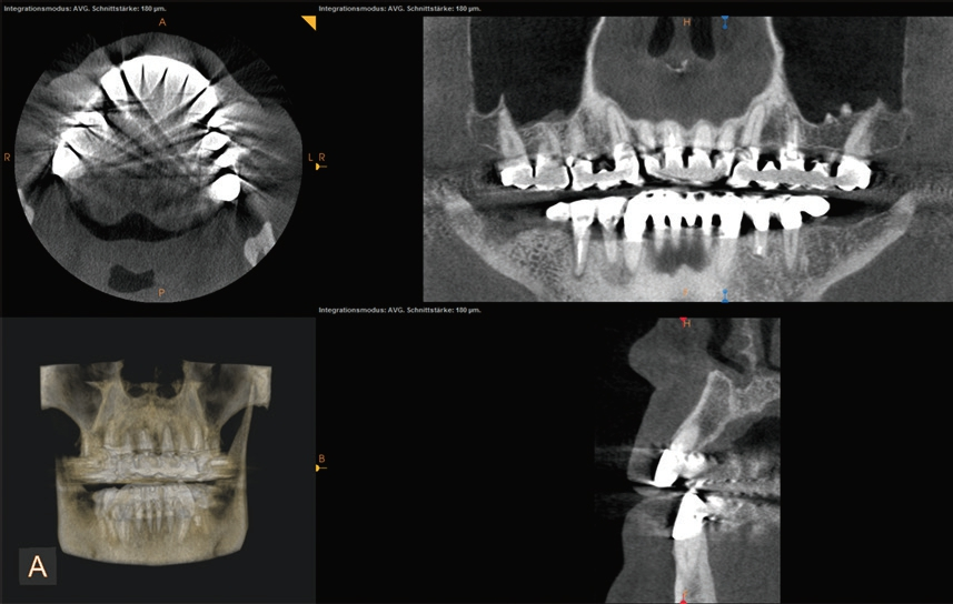 Abb. 4a: Darstellung metallischer Artefakte axial, coronal und sagittal.