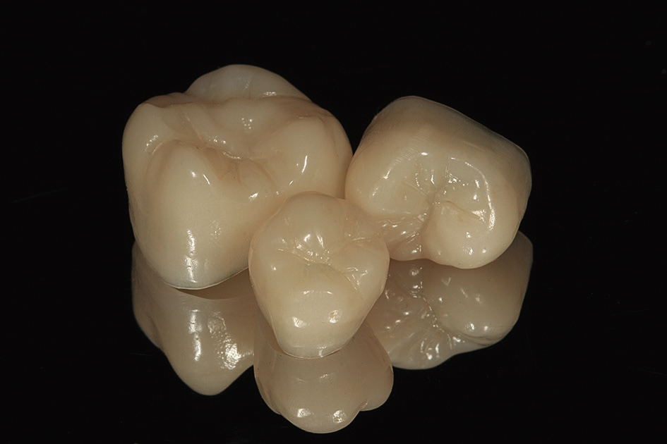 Abb. 7: Verblendfreie Kronen aus semitransparentem Zirkoniumdioxid nach Politur.