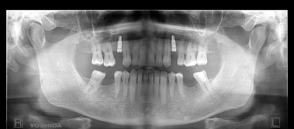 Abb. 3b: OPG viereinhalb Monate nach Augmentation mit Cerasorb® Paste und Setzen von zwei Implantaten in sehr gut knöchern regeneriertem Kieferkamm.