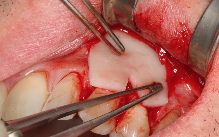 Abb. 7: Applikation der rehydrierten und in Form geschnittenen mucoderm® Matrix.