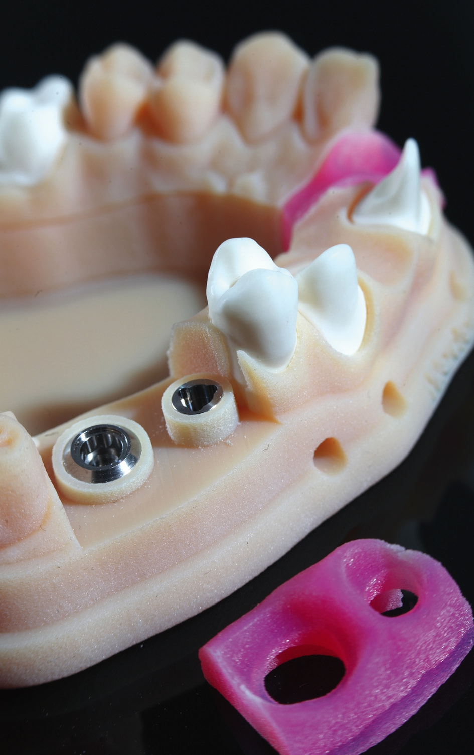 Abb. 8: Implantat-Modell mit CAD/CAM-Laboranalogen (3D Medical Print).