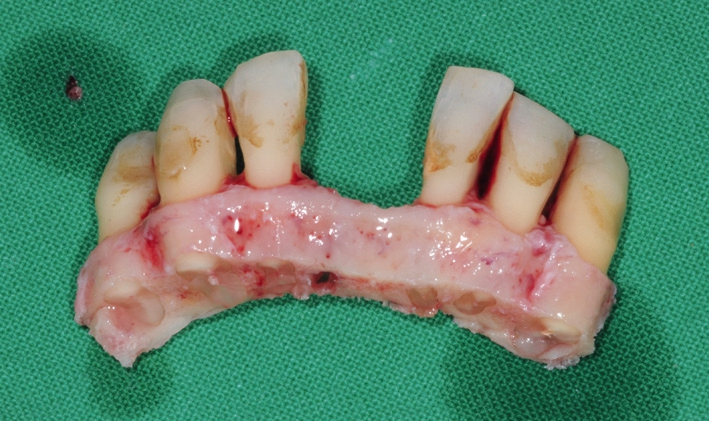 Abb. 7: Abgetrennter Alveolarkamm samt Zähnen.