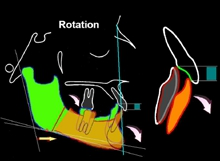 Abb. 7: Simulation einer operativen Unterkiefervorverlagerung ohne vorherige Nivellierung des UK-Zahnbogens. Es folgte eine Öffnung des Kieferwinkels durch die Rotation des UK-Segmentes während der Operation. Die vertikale blaue Linie berührt das Pogonion der Ausgangssituation; eine geringgradige Ventralverschiebung der Kinnprominenz. Eine zusätzliche labiale Kippung der Unterkieferfront ist zu beobachten.