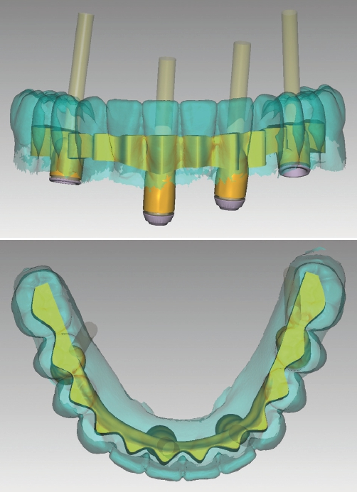 Abb. 11 u. 12: Gestaltung des Gerüstes mithilfe des Wax-up.
