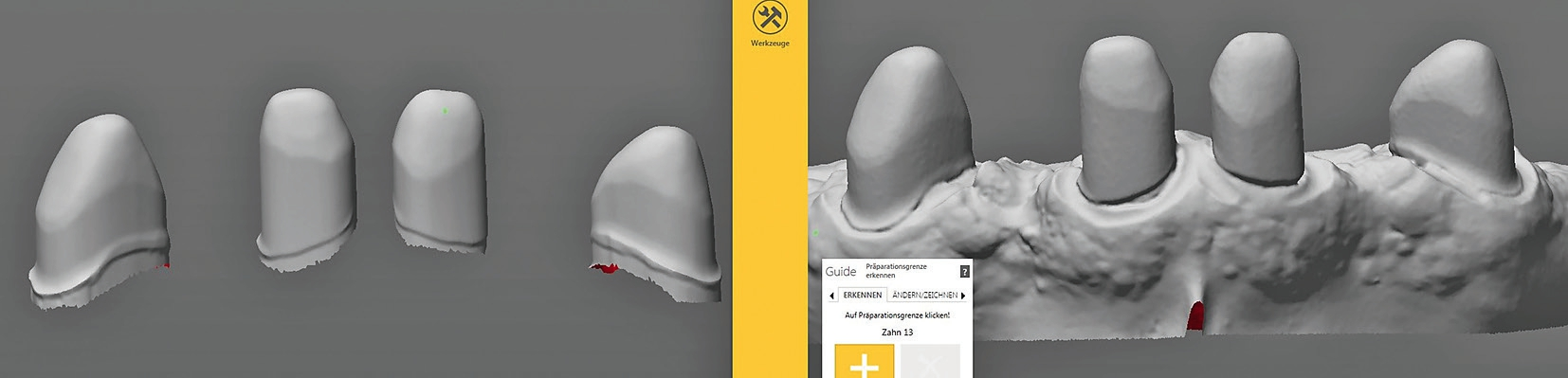 Abb. 6: Sehr gut erkennbar sind die Unterschiede zwischen den optisch und taktil gewonnenen Scanergebnissen: Die präziser ermittelten Scandaten mit dem Kontaktscanner bestechen durch eine genauere und feinere Darstellung der Einzelstümpfe.
