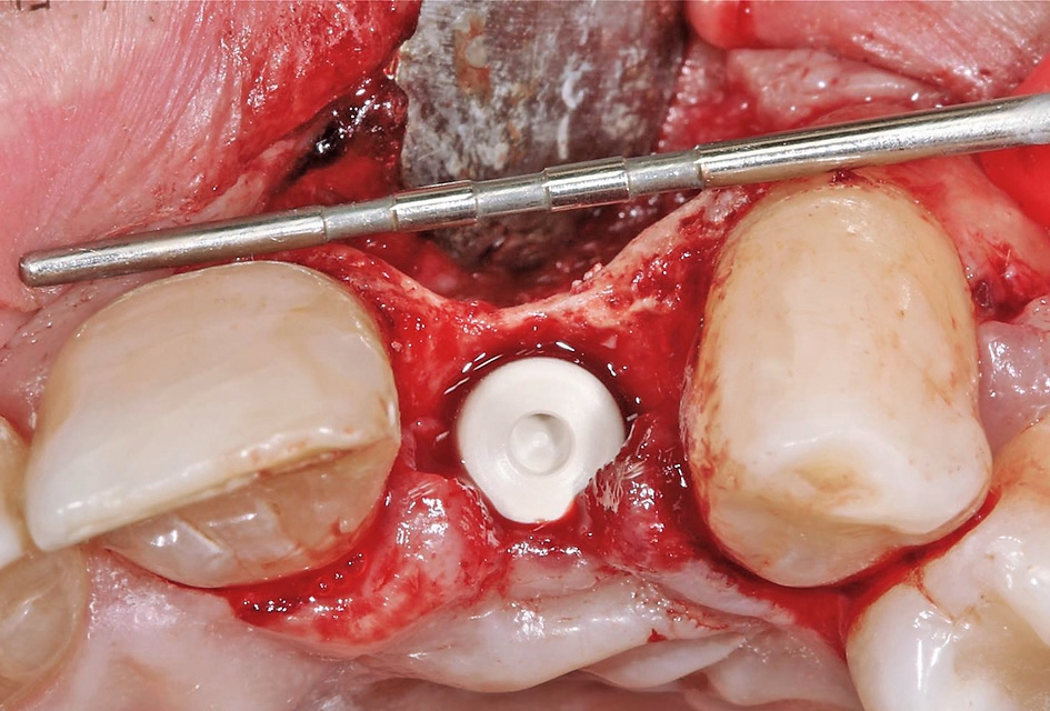 Abb. 7: Eine optimale Implantatposition für die Rekonstruktion mit einer direkt verschraubten Hybridabutmentkrone. Die Darstellung zeigt das ausgeprägte bukkale Knochendefizit. Zu sehen ist auch das seitlich eingebrachte Gemisch aus autologen Knochenspänen und Bio-Oss Collagen.