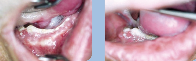 Abb. 10 u. 11: Klinischer intraoraler Status.