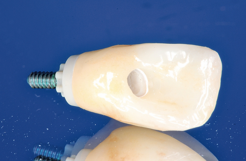 Abb. 22: Zur Ästhetik- und Funktionseinprobe wurden das PEKK-Abutment, die Laborschraube und die Zirkoniumdioxidkrone angeliefert.