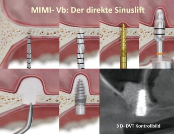 Abb. 17: Sowohl beim indirekten (MIMI Va) als auch beim direkten Sinuslift (MIMI Vb) erfolgt der Zugang nicht von einem lateralen Fenster (Prof. Hilt Tatum), sondern von krestal vom Kieferkamm aus. Von dort wird auch das Implantat inseriert. Beim direkten Sinuslift wird vor der eigentlichen Implantation der Knochendeckel angehoben und/ oder penetriert und die Schneidersche Membran ohne Verletzung mit Augmentat und/oder Blut angehoben. Alles erfolgt mit einfachem Instrumentarium wie – am Arbeitsende abgerundeten – Condensern oder linksdrehenden, mit etwa 30 bis 50 U/min arbeitenden, abgerundeten Spezial-Liftern.