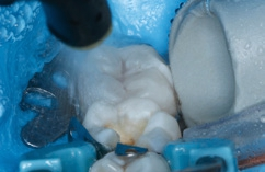 Abb. 7: Gründliches Absprühen der Phosphorsäure.