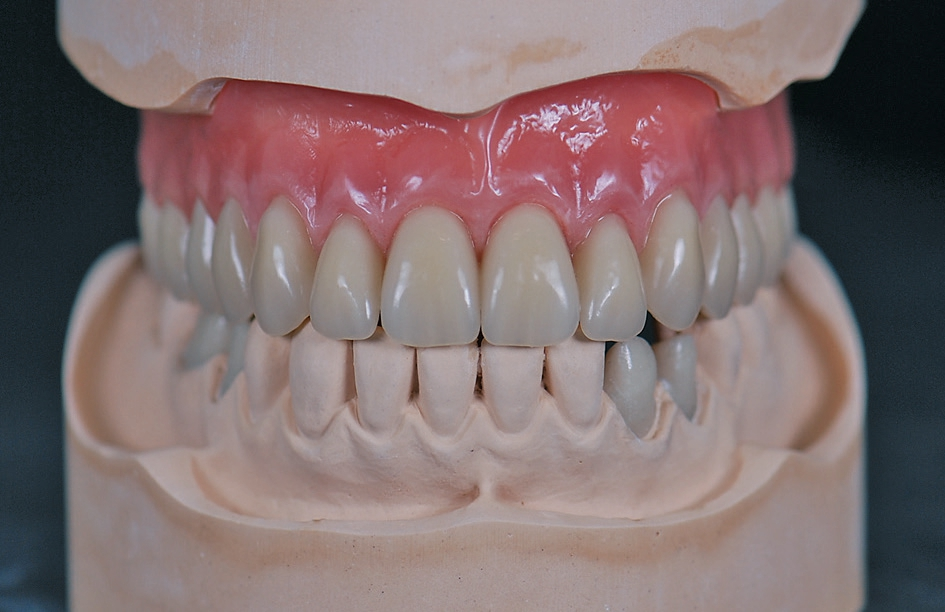 Abb. 8: Oberkieferprothese auf dem Meistermodell mit beschliffenen Zähnen regio 33, 34 und 45, 46.