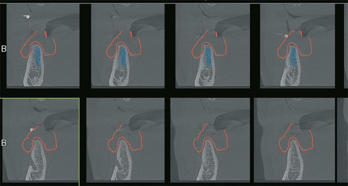 Abb. 7: Implantat regio 45 nochmals in verschiedenen Schnitten mit Nerv und Schleimhautdicke.