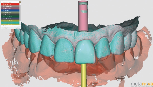 Abb. 7: Import der .STL-Daten von Scankörper, Modell und Wax-up in die exocad Software.