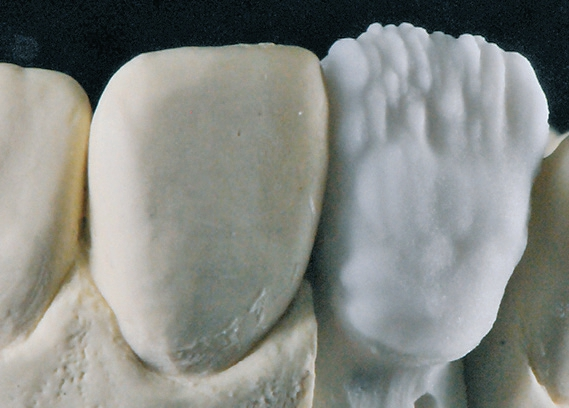Abb. 8: Schichten des Veneers 11 mit den IPS e.max Ceram Selection-Massen.