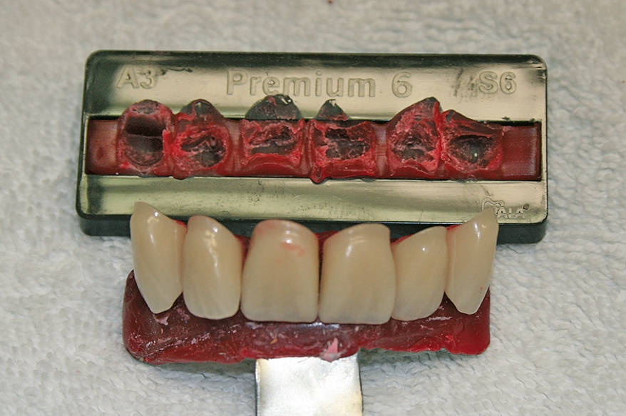 Abb. 3: Anhand der Formenkarte fiel die Zahnauswahl auf die Frontzahn-Linie Premium 6 (Kulzer, Hanau).