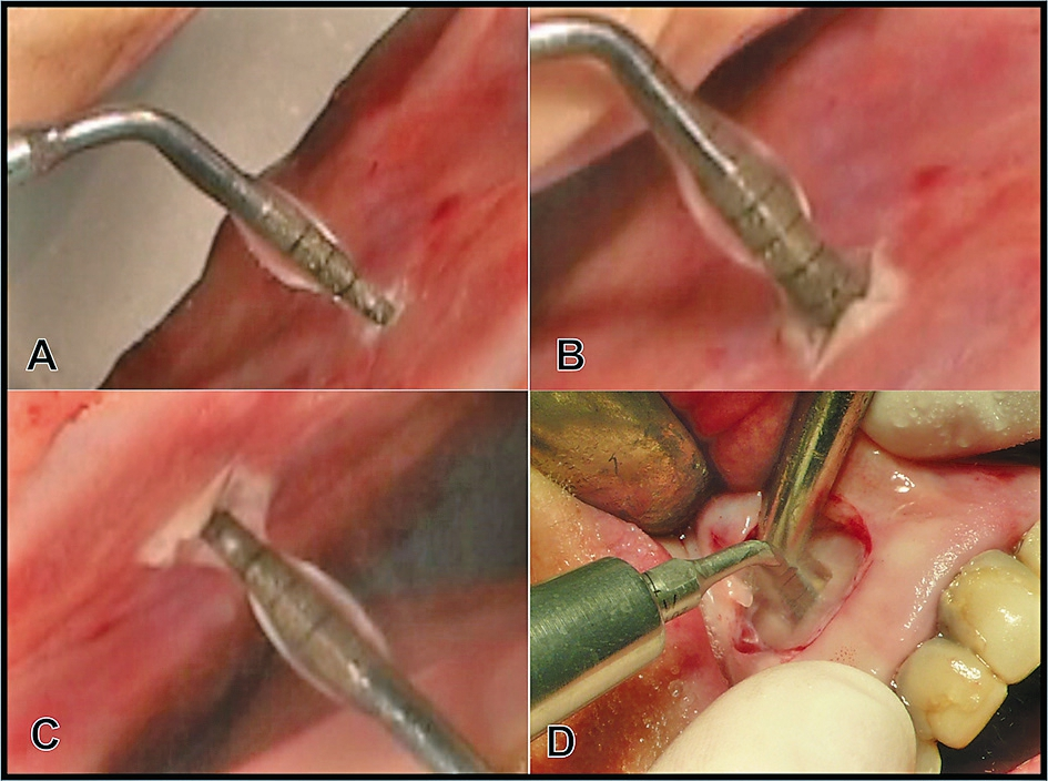 Abb. 7: A) Akustische Resonanzadhäsion von Kühlflüssigkeit an der Piezotom-Arbeitsspitze TKW 1 (Pilot-„Bohrer“ für den transcrestalen Kavitationssinuslift „INTRALIFT“ und für Implantbettaufbereitung), B) die akustische Resonanzadhäsion muss sich auf den Teil der Arbeitsspitze beschränken, der nicht in den Knochen versenkt wird, um eine optimale Kühlung zu garantieren und ist C) unabhängig vom Schwerkraftvektor. D) Wurzelspitzenresektion eines oberen 2ers mit dem Piezotome. Nach Präparation und Entfernung des Knochendeckels wird die Wurzelspitze mit der „NINJA“-Arbeitsspitze reseziert. Durch die harmonischen Oszillationen sind die optimale Kühlung und der Kavitationseffekt durch das Anhaften der Kühlflüssigkeit gewährleistet, die auch nicht im OP-Gebiet verteilt wird.