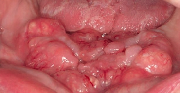 Abb. 7: Plattenepithelkarzinom des Unterkiefers.