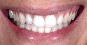 Abb. 7: Nach Zahnaufhellung und Eingliederung der Lithium-Disilikat-Veneers – ein hochästhetisches Ergebnis (Keramik-Spezialist: Marco Gesuato, Laboratorio Galleti, Pesaro, Italien).