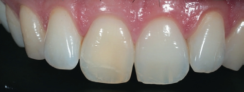 Abb. 8: Endodontisch behandelter Zahn 11 nach Bleaching.