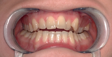 Abb. 7: Erosionsschäden durch Missbrauch von Bleaching-Agenzien bei einer jungen Patientin.