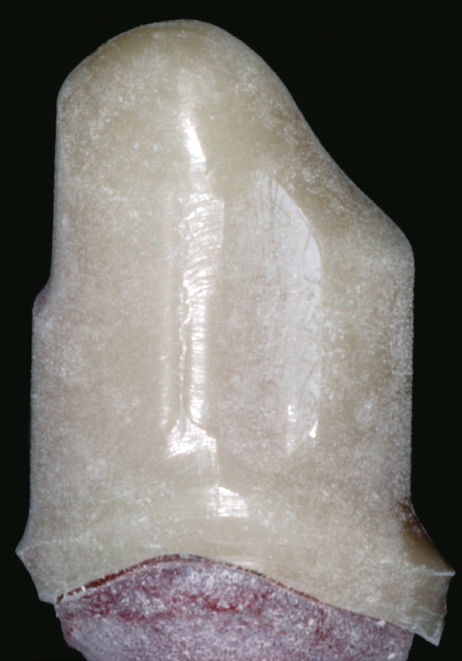 Abb. 7: Mit Zirkoniumdioxid-Pulver entspiegelte Zirkoniumdioxid-Primärkrone.