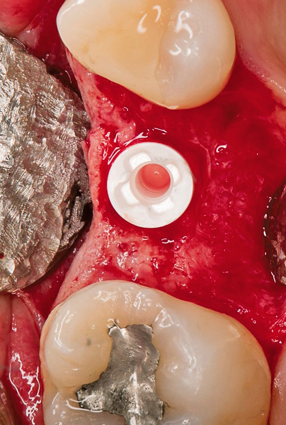 Okklusale Ansicht nach Implantatinsertion und der Innenverbindung des zweiteiligen Keramikimplantatsystems NobelPearl(TM).