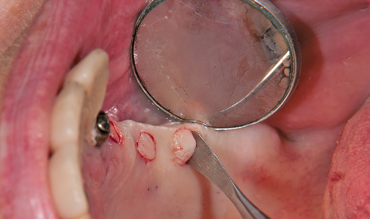 Abb. 7: Entfernen der gestanzten Gingiva mit einem Rasparatorium.