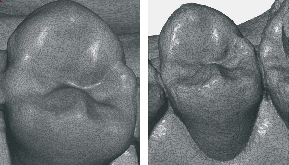 Abb. 7a u. b: Vergleich der Scanauflösung zwischen einem Scan mit der CEREC Omnicam (links) und der CEREC Bluecam (rechts).