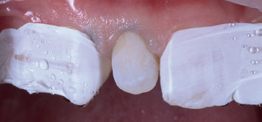 Abb. 7: Situation nach gründlicher Entfernung des Phosphorsäure-Gels.