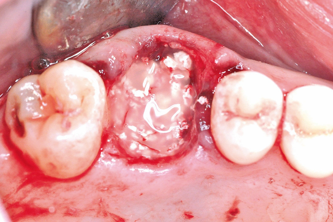 Abb. 7: Auffüllung der Alveole mit einem partikulären Knochenersatzmaterial (cerabone ®, botiss biomaterials, Zossen, Deutschland), welches mit Schmelzmatrixproteinen (Straumann® Emdogain®, Institute Straumann AG, Basel, Schweiz) benetzt wurde.