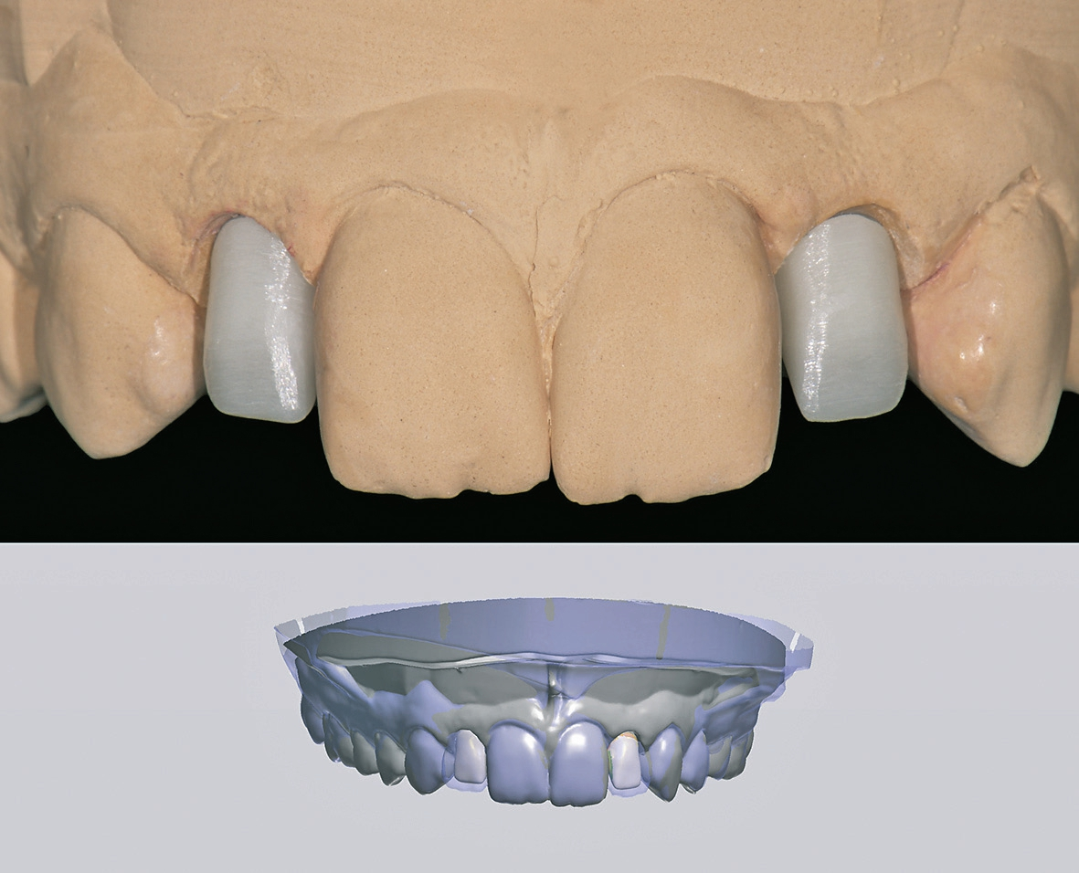 Abb. 7: In verkleinerter anatomischer Form gefräste Zirkoniumdioxidkappen.