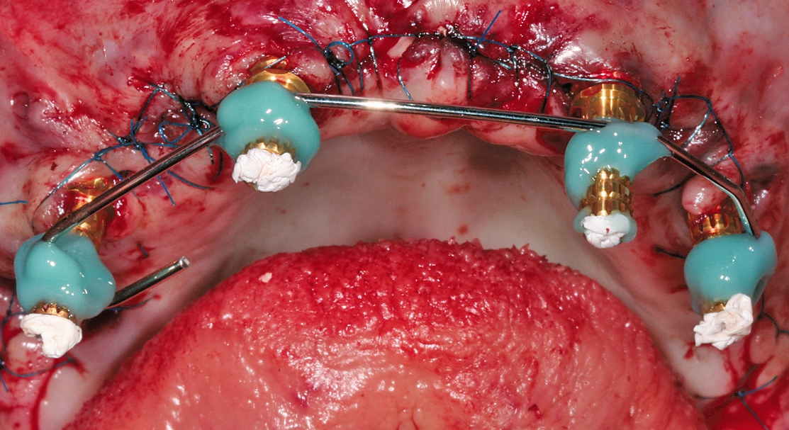 Abb. 7: Sicherung der Implantatpositionen gegen Verzug des Abformmaterials.