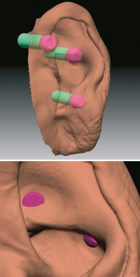 Abb. 6a u. b: Anwendung von virtuellen Konfektionsteilen als Platzhalter. Oben: Im weiteren digitalen Ablauf werden die Retentionselemente (violett) zur Verankerung der Epithese auf den erfassten Implantaten (grün) in die Konstruktion virtuell für die digitale Anprobe eingebracht. Unten: Aufgrund des Platzmangels müssen die perforierten Bereiche der Retentionsmagneten noch virtuell mit ausreichender Schichtdicke abgedeckt werden. Die passenden Konfektionsteile (hier: Magnete) werden in der erstellten Epithese einpolymerisiert.