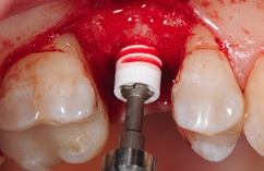 Abb. 8: Implantatinsertion mit dem Inter-XEinbringinstrument.