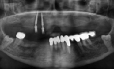 Abb. 7: Das Röntgenbild nach Verlust zweier Interimsimplantate.