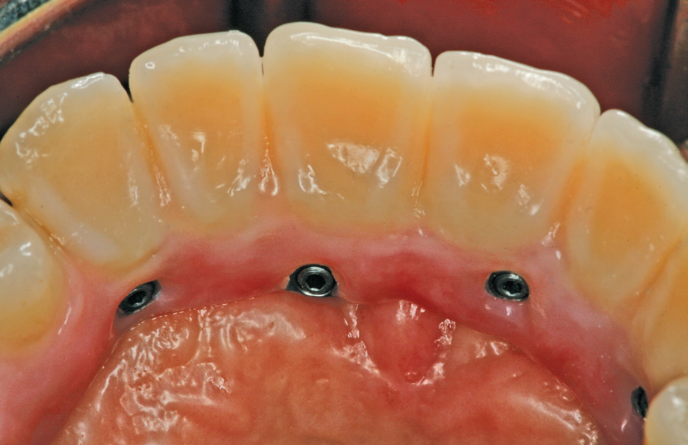 Abb. 9: Nahansicht der Schraubenkanäle der anterioren Implantate im palatinalen Bereich.
