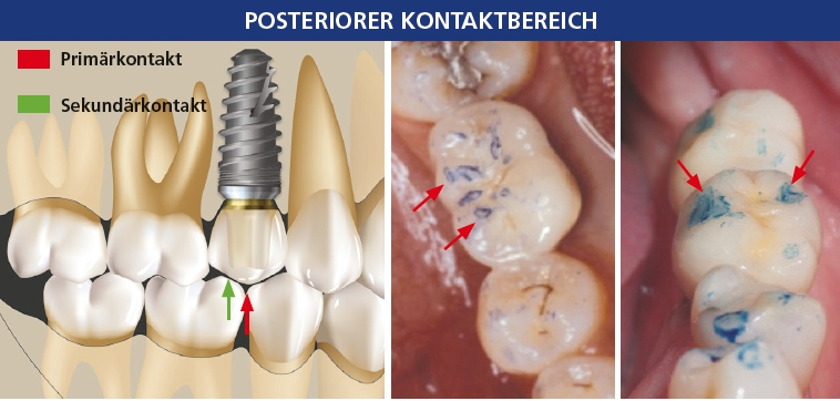 Abb. 5a: Die idealen primären Okklusalkontakte der posterioren Implantatprothese befinden sich innerhalb des Implantatdurchmessers, im Bereich der zentralen Fossa der Krone. Der okklusale Sekundärkontakt sollte mindestens 1 mm von der Implantatperipherie entfernt bleiben, um Belastungen durch Drehkräfte zu verringern. Abb. 5b und c: Beispiele für Okklusalkontakte an den Höckerwinkeln anstelle der zentralen Fossa, was zu einer verstärkten Scherbelastung am Implantat führt und die physiologische Grenze der Druck- und Zugkraft auf den krestalen Knochen verschiebt.