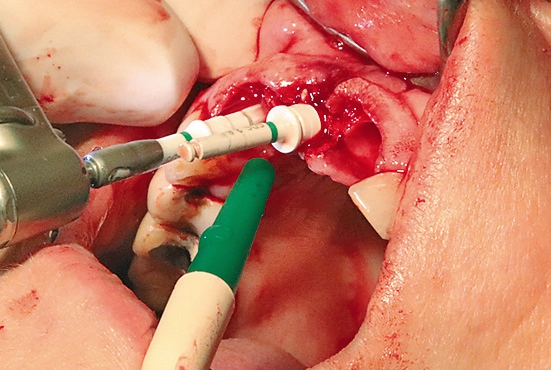 Abb. 8: Aufbereitung des Implantatbettes.
