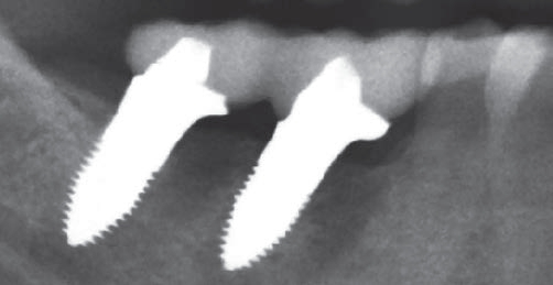 Abb. 9: Die Röntgenkontrolle nach 6,5 Monaten zeigt eine teilweise Knochenregeneration in den Extraktionsalveolen.