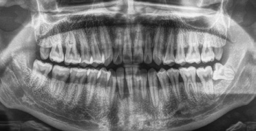 Abb. 2: Orthopantomogramm bei Erstvorstellung.