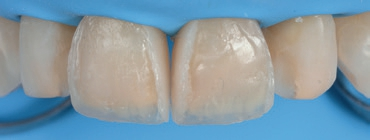 Abb. 7: Schichtung der Kompositverblendungen: Zuerst wurde eine Schicht „Dentinmasse“ aufgetragen.
