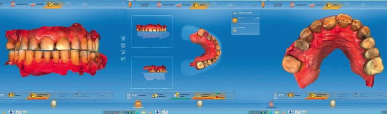 Abb. 7: Ausgangssituation: Patient mit generalisierten Abrasionen, Cerec-Scan der intraoralen Situation. Therapieplan: Rehabilitation regio 13 bis 23 mit Teilkronen und Veneers, Bisserhöhung im UK.