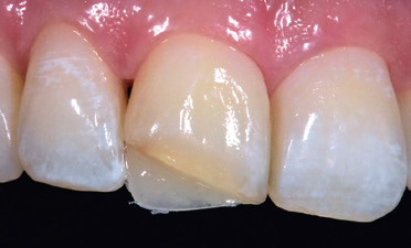 Abb. 7: Die fabrizierte stabile primäre palatinale Wand dient als „Verschalung“ und steht bereit zum Aufschichten weiteren Materials.