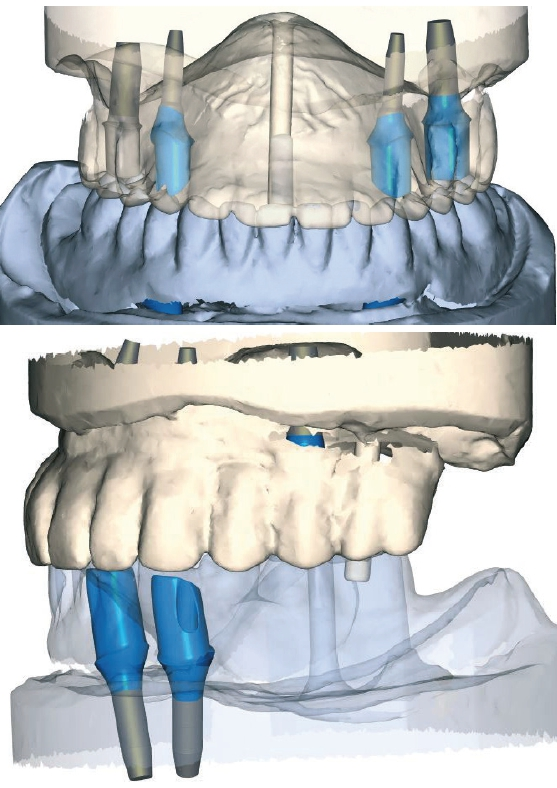 Abb. 66 u. 67: Von Atlantis gesendeter Design-Vorschlag. Auch hier war gut erkennbar, dass die Implantate optimal stehen.