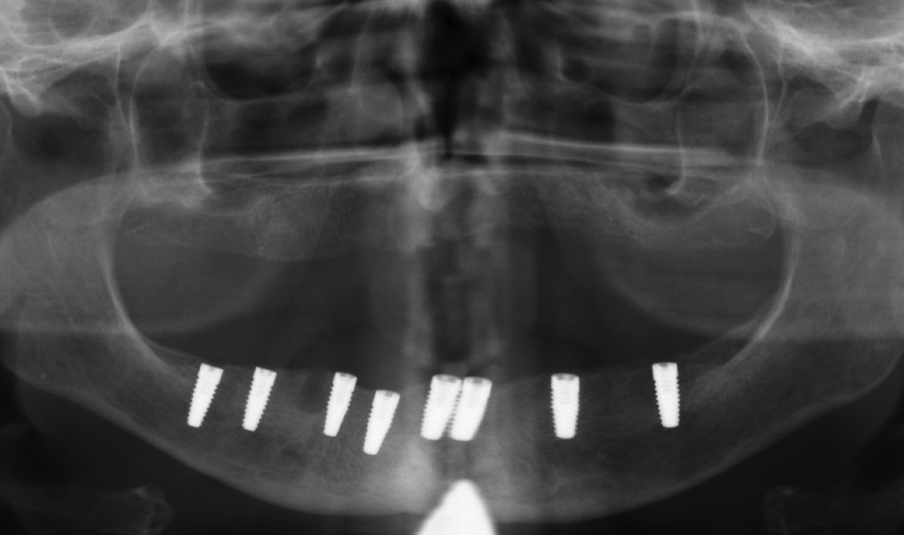 Abb. 7: Kontrollröntgenbild nach Implantation.