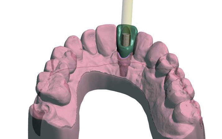 Abb. 5c: CAD-Provisorium palatinal.