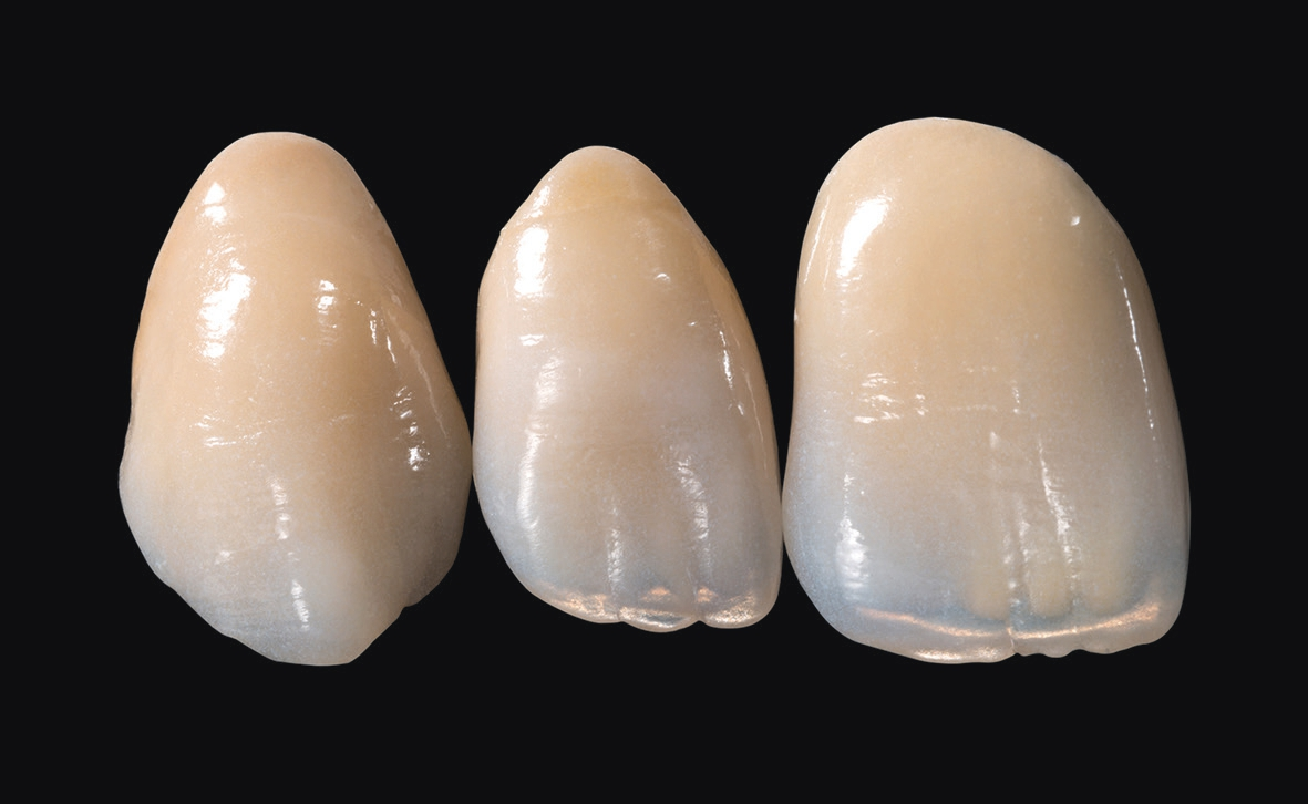 Abb. 7: Zähne in all ihren körperhaften und farblichen Nuancen naturidentisch imitieren – moderne Dentalkeramiken und zahntechnische Handwerkskunst macht es möglich.
