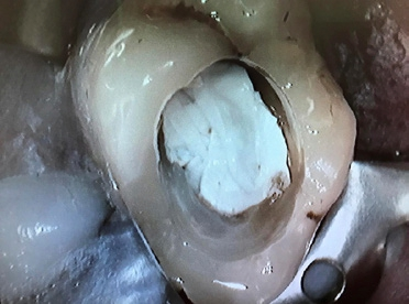 Abb. 6: Möglicher Einsatz der Teflonfolie beim präendodontischen Aufbau oder unter provisorischer Füllung.