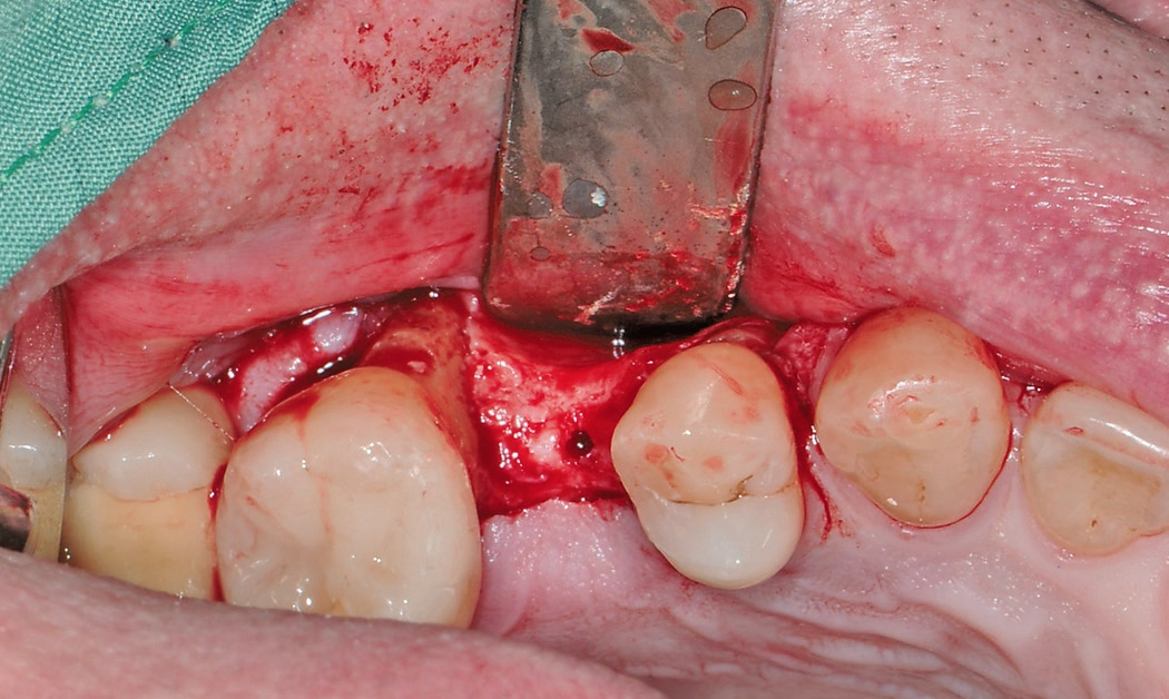 Abb. 6: Angekörnte Implantatposition; sichtbare Einziehung des bukkalen Kieferkammes in typischer Sanduhrform.