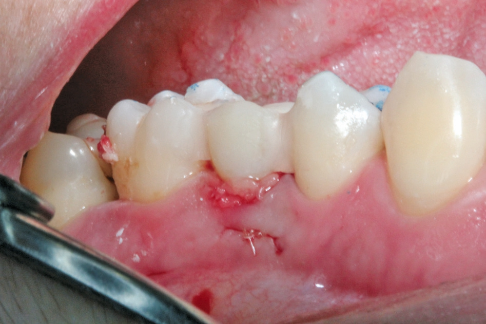 Abb. 7: Fertiges Sofortimplantat mit Provisorium.